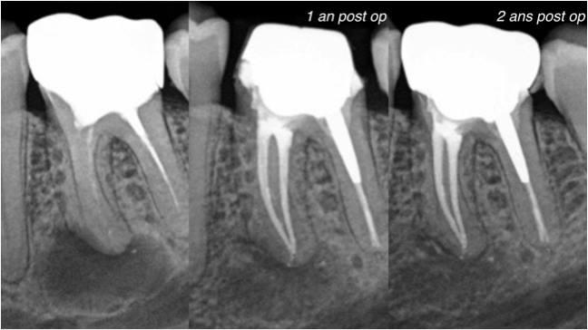 Pronostics et suivis en endodontie