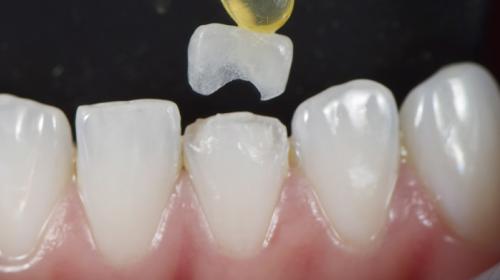 Chipping céramique en prothèse implante-portée